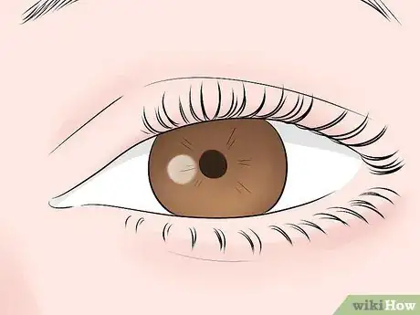 Image titled Diagnose Tuberous Sclerosis Step 4