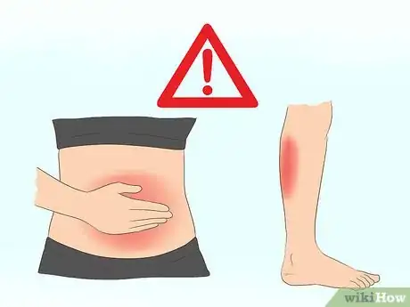 Image titled Diagnose Celiac Disease Step 1