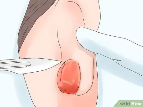 Image titled Treat an Infected Ear Piercing Step 5