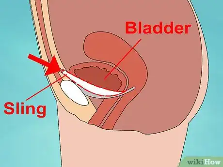 Image titled Avoid Bladder Leaks While Running Step 9