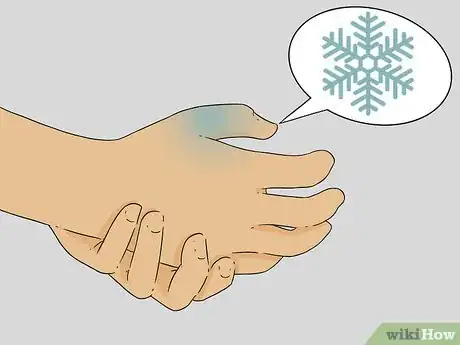 Image titled Diagnose a Broken Thumb Step 4