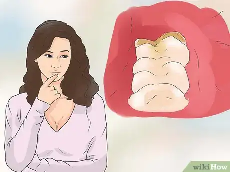 Image titled Relieve an Impacted Tooth Step 1