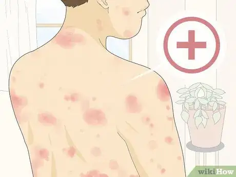 Image titled Recognize Hives (Rash) Step 8