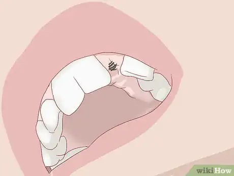 Image titled Know What to Expect when Getting a Tooth Implant Step 14