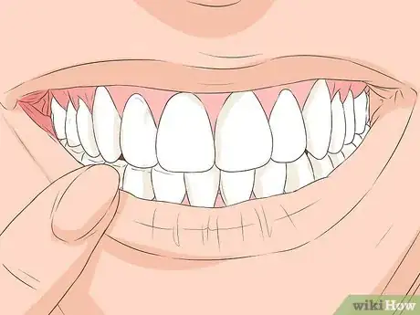 Image titled Heal a Bitten Tongue Step 20