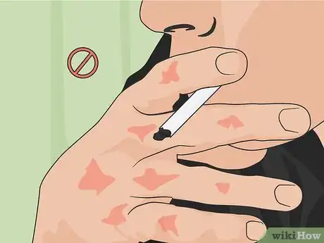 Image titled Help Control Psoriasis with Lifestyle Changes Step 09