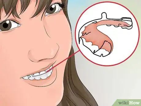 Image titled Avoid Getting Braces Step 4