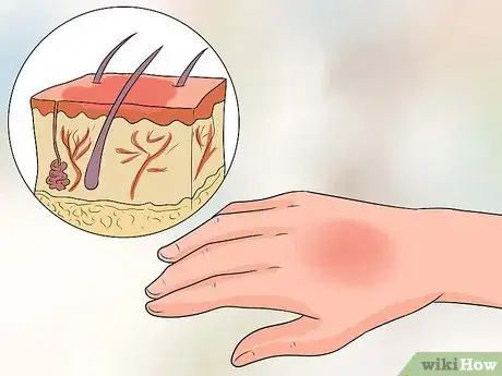 Image titled Treat a Hot Water Spill on Your Skin Step 1
