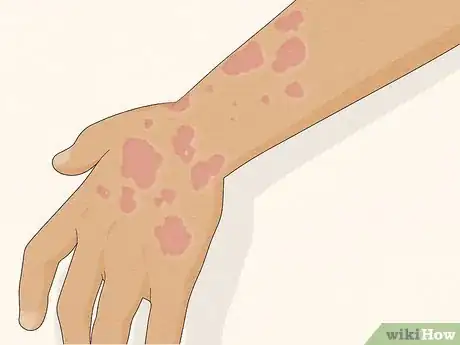 Image titled Recognize Hives (Rash) Step 2