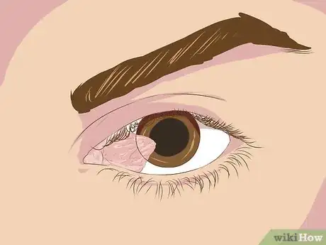 Image titled Diagnose Surfer's Eye Step 1