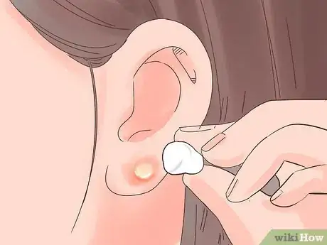 Image titled Treat an Infected Ear Piercing Step 8
