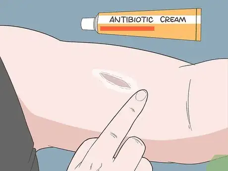 Image titled Treat Skin Picking Wounds Step 3