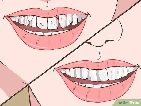Image titled Straighten Your Teeth Without Braces Step 6