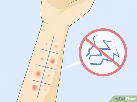 Image titled Patch Test Skin Step 5