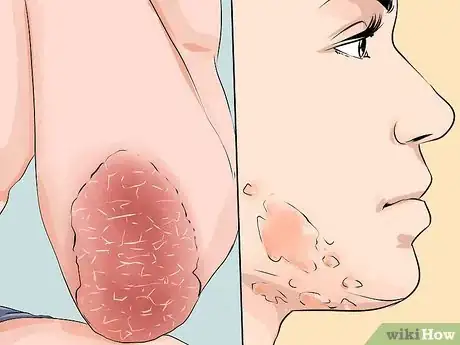 Image titled Reduce Eczema Itching Step 19