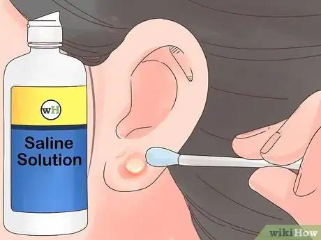 Image titled Treat an Infected Ear Piercing Step 9