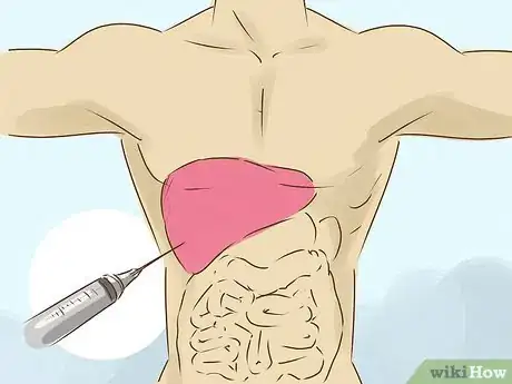 Image titled Diagnose Liver Cancer Step 11