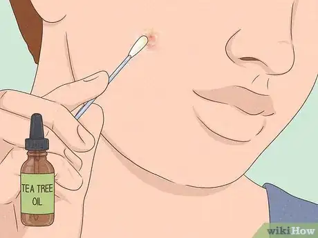 Image titled Get Rid of a Zit Overnight Step 4