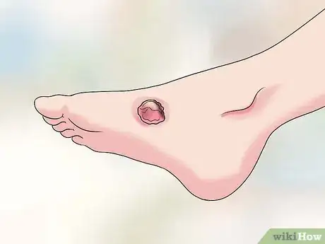 Image titled Cure Jungle Rot Step 1