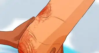 Care for Your Prosthesis