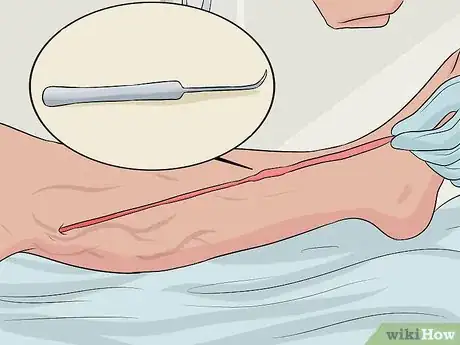 Image titled Get Rid of Varicose Veins Step 14