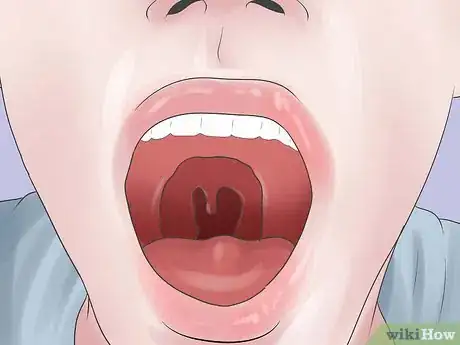 Image titled Diagnose Tonsillitis Step 2