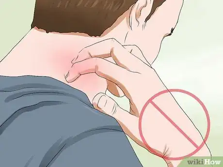 Image titled Know if You Have Eczema Step 3