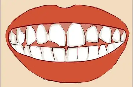 Image titled Consider composite bonding
