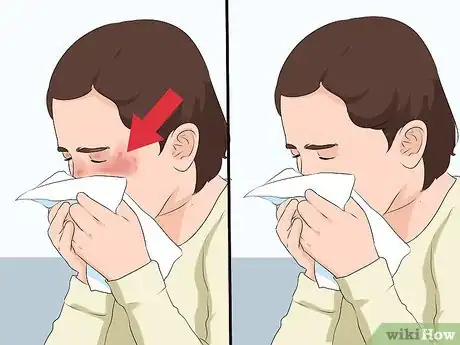 Image titled Identify a Seasonal Allergy Reaction in Young Children Step 7