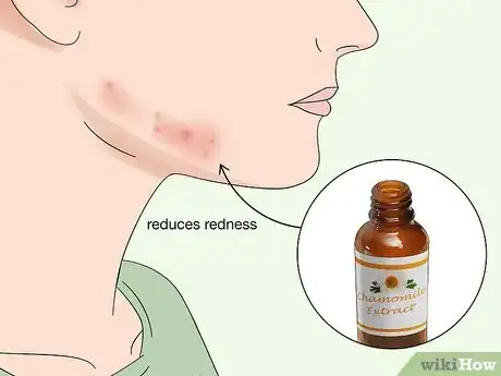 Image titled Use Herbs to Treat Acne Step 4