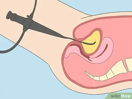 Image titled Diagnose Bladder Cancer Step 7