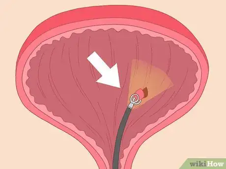 Image titled Diagnose Bladder Cancer Step 8