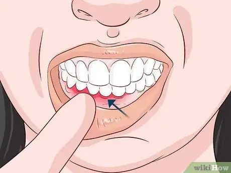 Image titled Get Rid of Plaque Naturally Step 14
