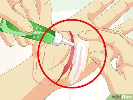 Image titled Care for Superficial Wounds Step 11