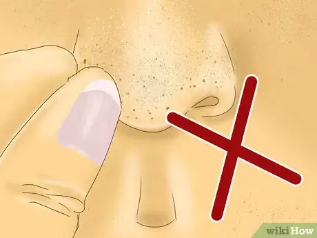 Image titled Get Rid of Blackheads and Whiteheads Using Commercial Products Step 8