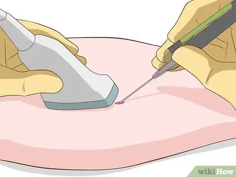 Image titled Treat Bicep Tendonitis Step 10