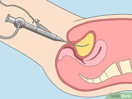 Image titled Diagnose Bladder Cancer Step 6