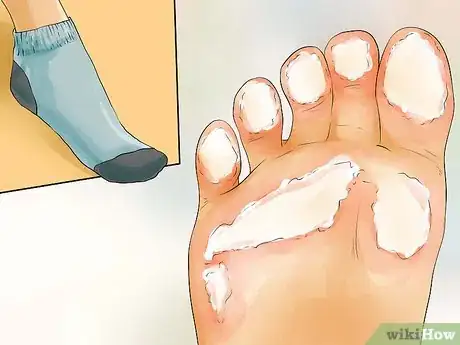 Image titled Heal Dry Skin on Your Feet Step 8