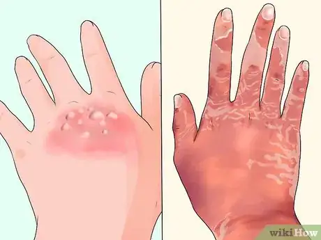 Image titled Diagnose Primary Immunodeficiency Step 2