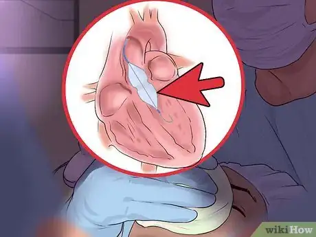 Image titled Cope With Mitral Valve Prolapse (MVP) Step 8