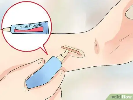 Image titled Prevent Keloid and Hypertrophic Scars Step 7