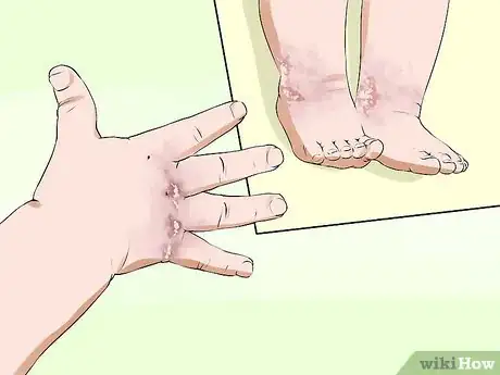 Image titled Know if You Have Eczema Step 4