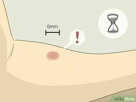 Image titled Test for Tuberculosis Step 4