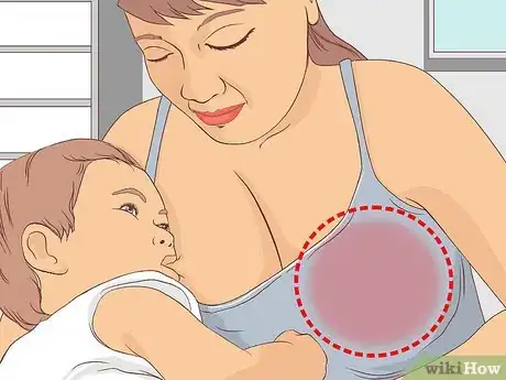Image titled Avoid Sore Nipples While Breast Feeding Step 2