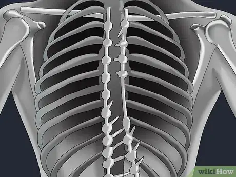 Image titled Deal With Scoliosis Surgery Step 4