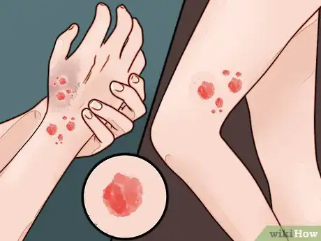 Image titled Reduce Lymphoma Risk with Psoriasis Step 3