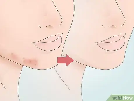 Image titled Cover Inflamed Pimples Step 11