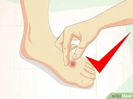 Image titled Care for Superficial Wounds Step 17