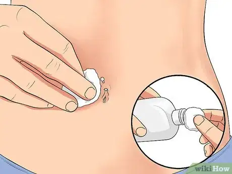 Image titled Treat an Irritated Belly Button Piercing Step 1