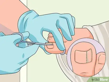 Image titled Cure Nail Fungus Step 12